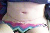 Scar after tummy tuck images