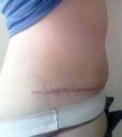 Scar after tummy tuck photo