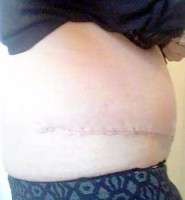 Scar after tummy tuck picture