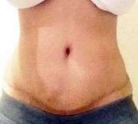 Scar after tummy tuck surgery