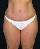 Scar from tummy tuck image