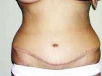 Scar from tummy tuck surgery