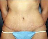 Scar tissues after tummy tuck