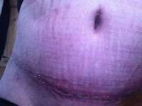 Scars after tummy tuck picture