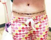 Scars from the tummy tuck