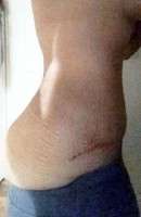 Scars from tummy tuck photo