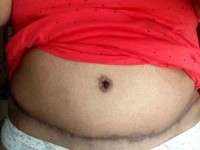 Scars tummy tuck image patient