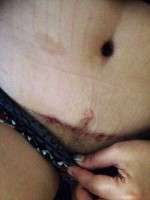 Scars tummy tuck surgery