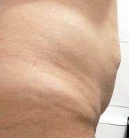 Should i lose weight before tummy tuck