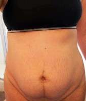Should you lose weight before abdominoplasty