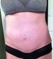 Sign of seroma after tummy tuck