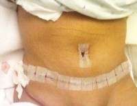 Signs of seroma after a tummy tuck