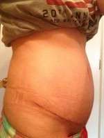Signs of seroma after abdominoplasty