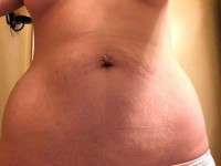 Stretch marks tummy tuck picture