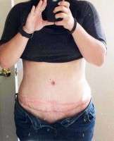 Swelling 3 months after tummy tuck surgery