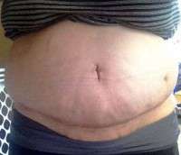 Swelling 6 weeks after tummy tuck image