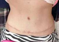 Swelling after a tummy tuck image