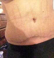 Swelling after tummy tuck and lipo picture