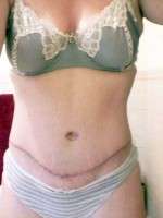 Swelling after tummy tuck and liposuction