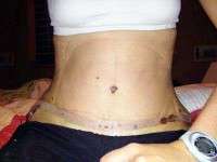 Swelling after tummy tuck operation