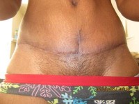 Swelling after tummy tuck surgery abdominoplasty