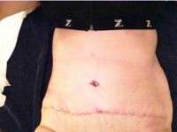 Swelling after tummy tuck surgery