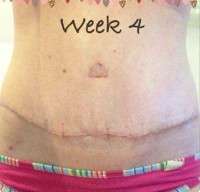 Swelling tummy tuck week 4