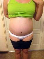 The abdominoplasty after pregnancy