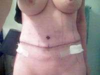 The numbness after tummy tuck