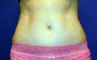 The scar from tummy tuck operation