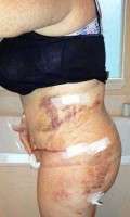 The scars from tummy tuck