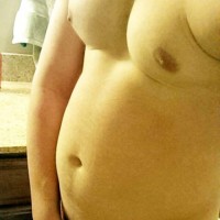 The surgery to remove visceral fat