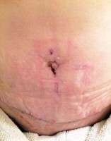 The swelling 3 months after tummy tuck