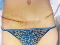 The swelling after a tummy tuck