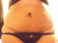 The swelling after a tummy tuck surgery