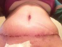 The swelling after tummy tuck