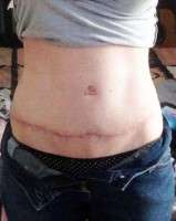 The swelling after tummy tuck and lipo