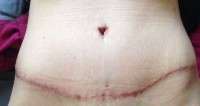 The tightness after tummy tuck