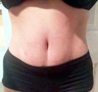 The tummy tuck after delivery