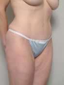 The tummy tuck incision