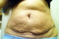 The tummy tuck operation or liposuction before