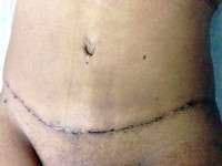 The tummy tuck recovery swelling