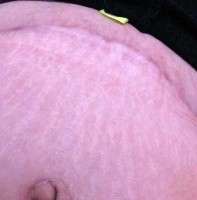 The tummy tuck surgery post op swelling