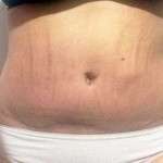 The tummy tuck swelling photos