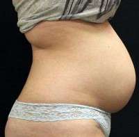 The tummy tuck then pregnancy