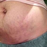 Tummy tuck after c section image
