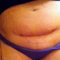 Tummy tuck after c section photo