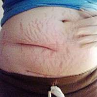 Tummy tuck after caesarean section