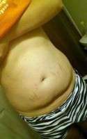 Tummy tuck after delivery image