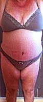 Tummy tuck after delivery photo